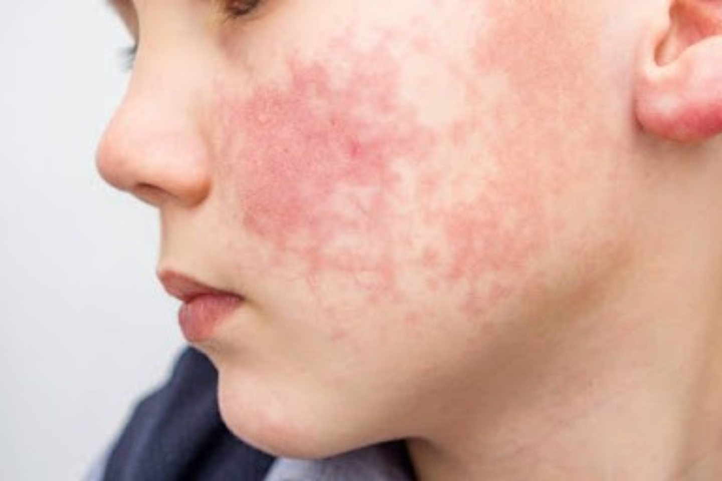allergy treatment